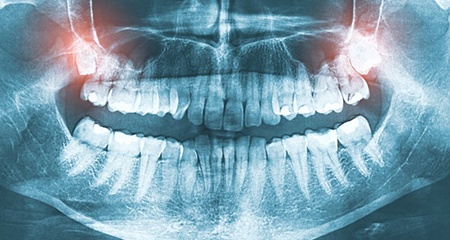 Dental X-ray with top wisdom teeth highlighted in red