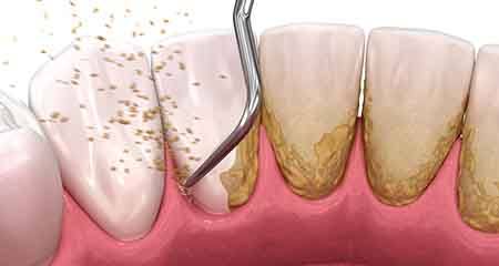 Digital illustration of scaling & root planing