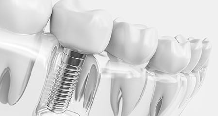 Dental implants are reliable but still have the potential to fail